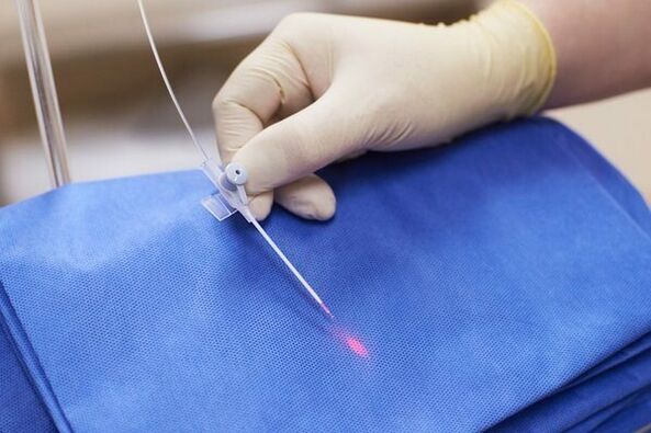 In some cases, laser therapy is used to treat chronic prostatitis