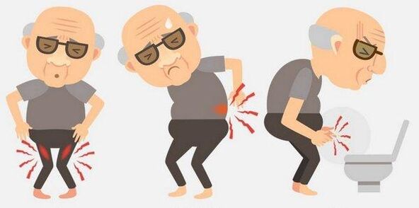 Prostatitis symptoms