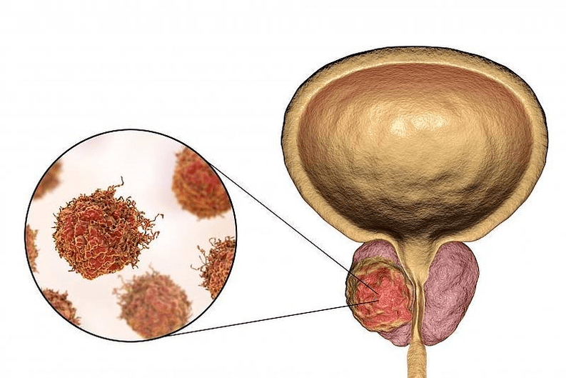 what prostate lesions look like