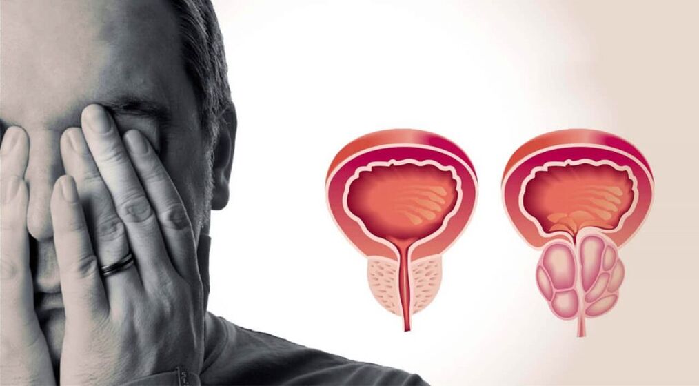Healthy and inflamed prostate